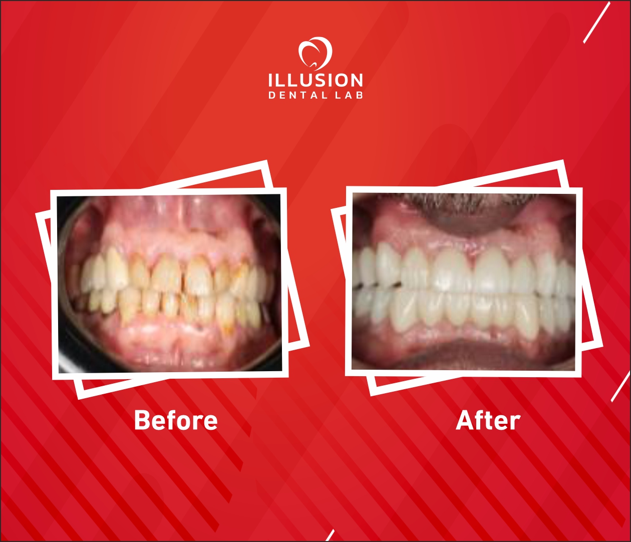 full mouth restoration with zirconia crowns